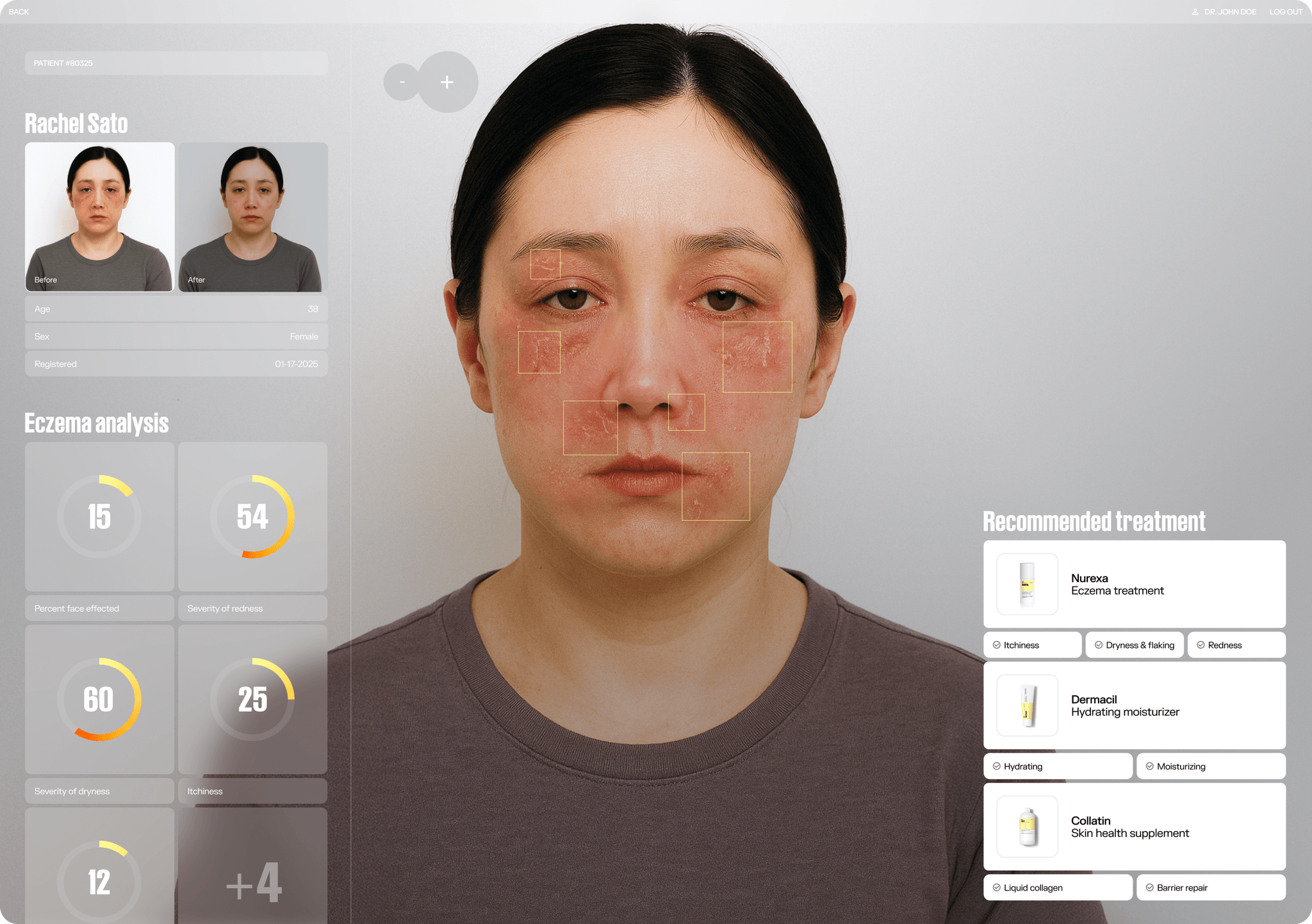 Eczema Before